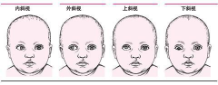 斜视是什么意思?