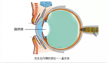 白内障都有哪些主要症状呢？