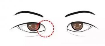 为什么做双眼皮手术，医生会建议你开眼角？